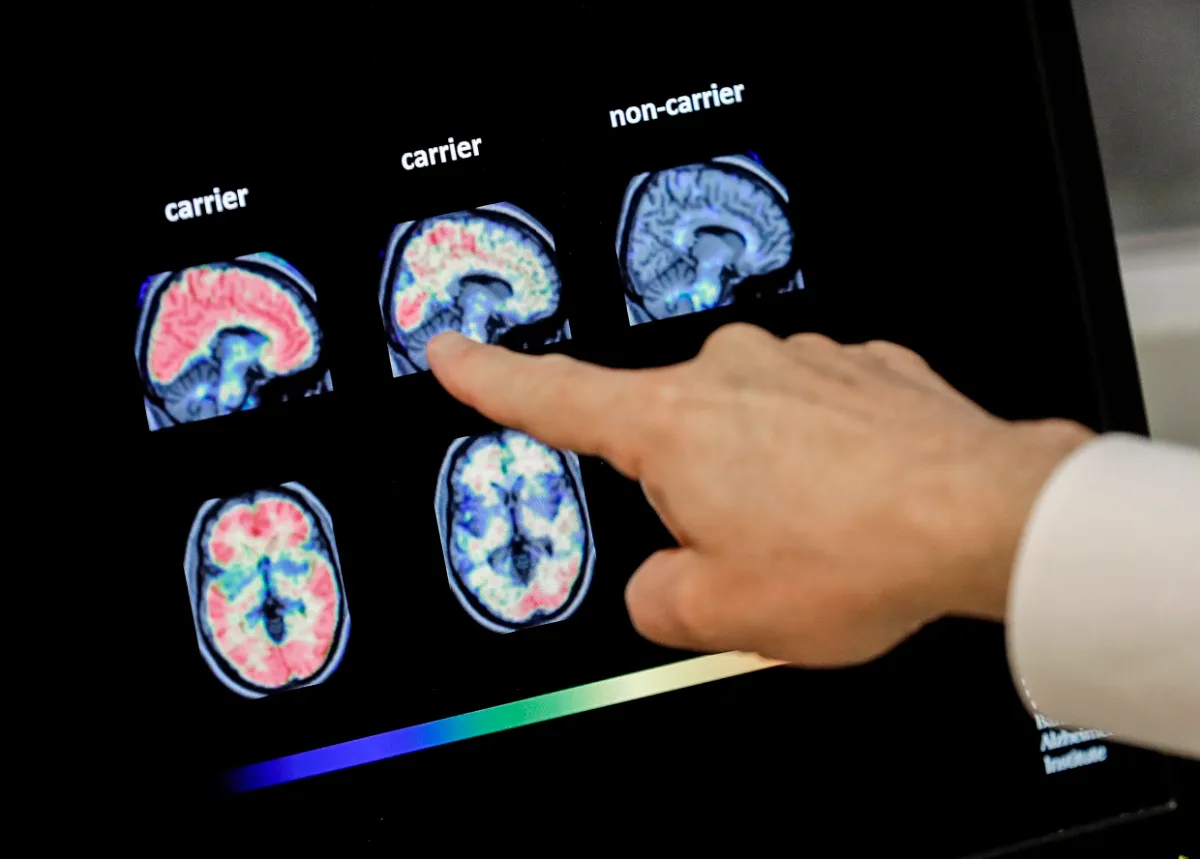 LEQEMBI — a breakthrough in treatment of Alzheimer’s disease