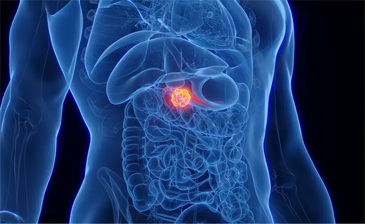 MIT researchers develop AI models enhancing early detection of pancreatic cancer